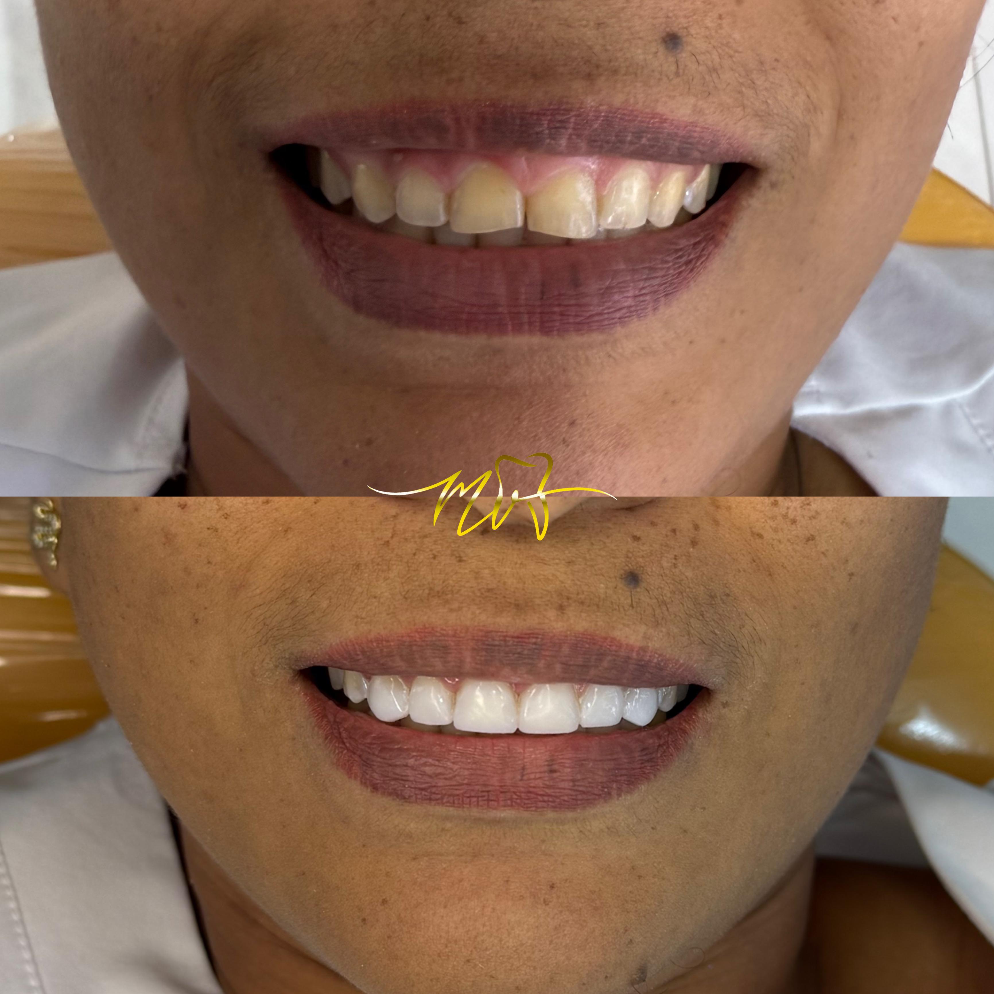 Caso de diseño de sonrisa, vista 1