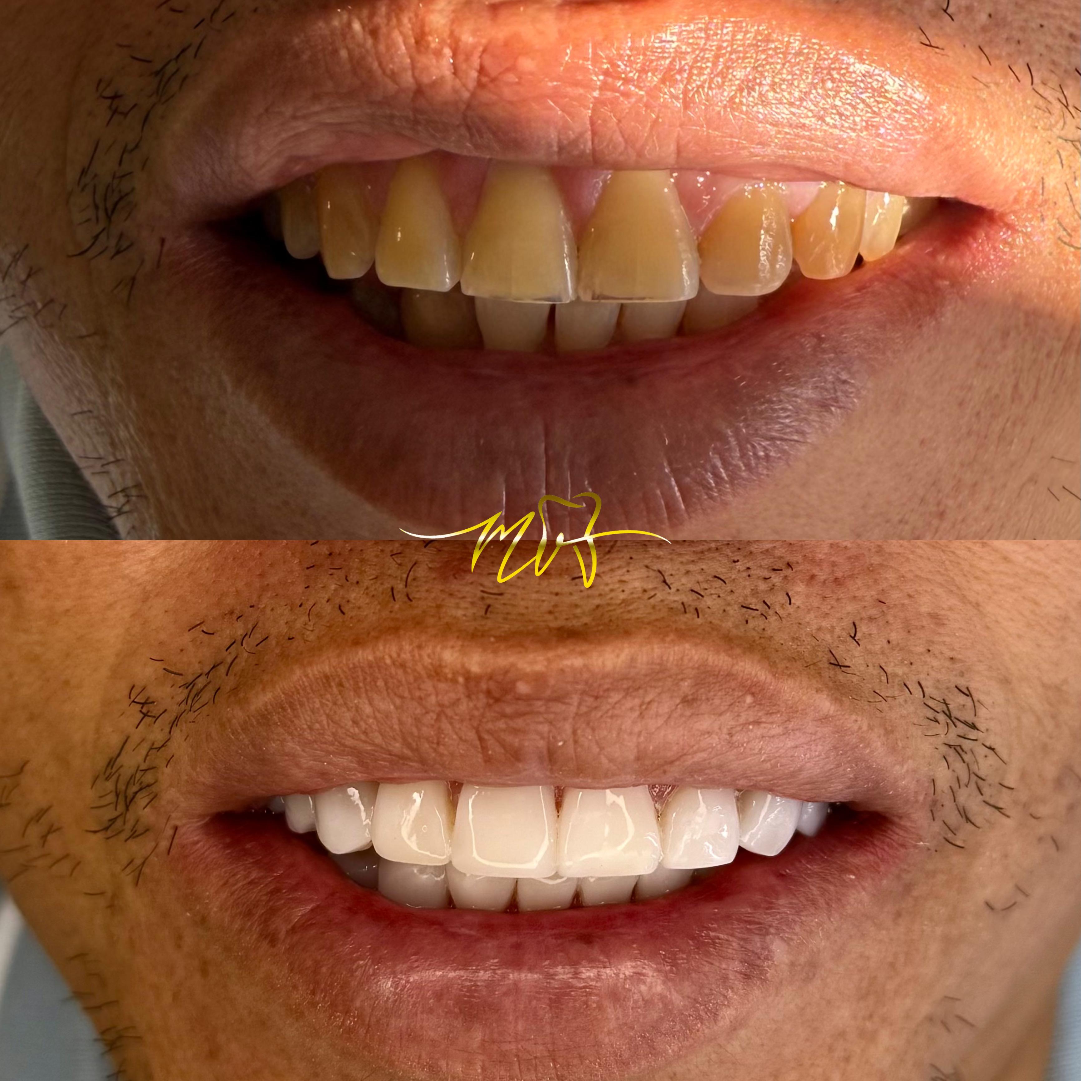 Caso de diseño de sonrisa, vista 4